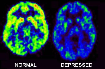 cerebro con depresión