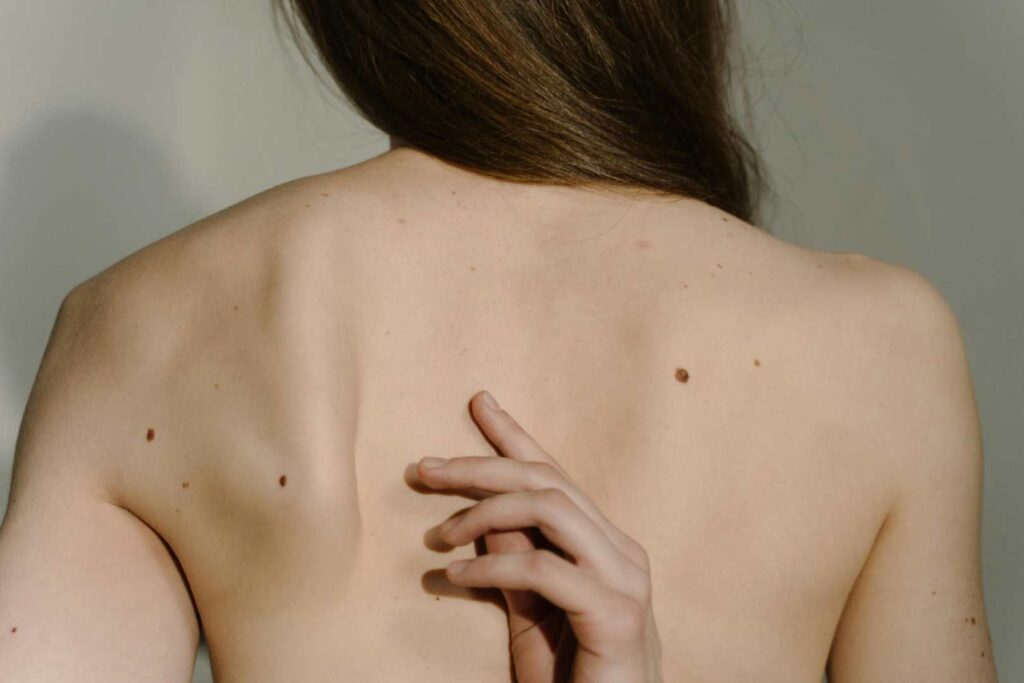 Significado lunares en el cuerpo